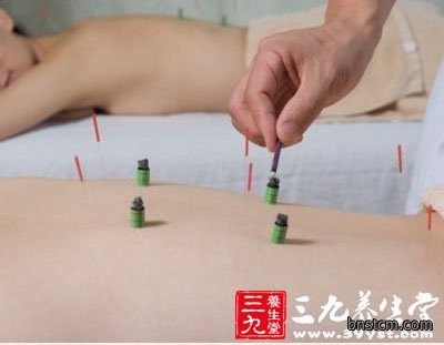 艾灸治疗前列腺炎