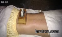 中医艾灸养生