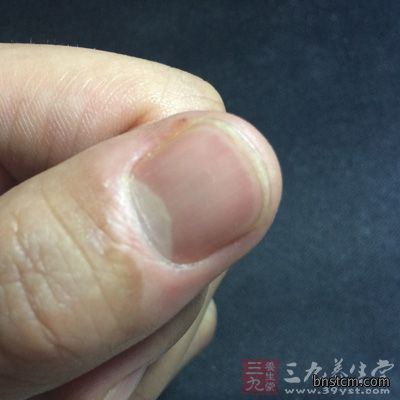 指甲出现白点或絮状白斑