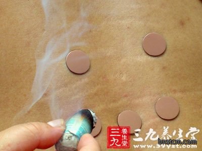 艾灸疗法治疗鼻炎